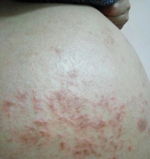 跑完后皮肤痒怎么办（跑步机让你皮肤痒痒怎么解决）