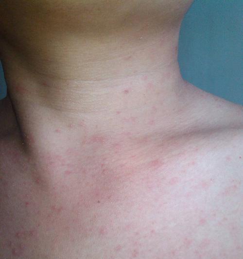 吹空调受风了怎么办？如何快速缓解症状？